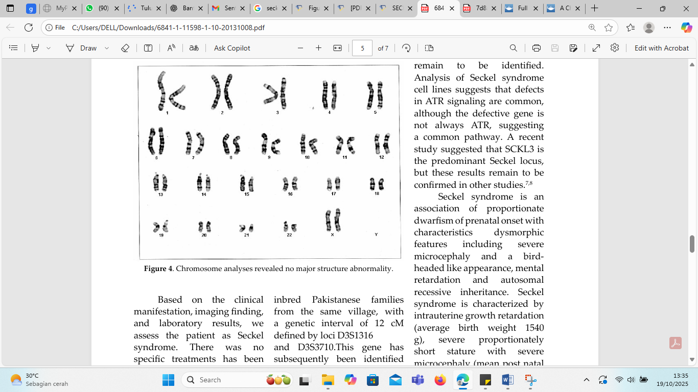 Jejak Gen dalam Tubuh Kecil: Menyingkap Rahasia di Balik Seckel Syndrome