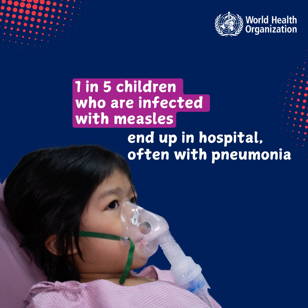 Komplikasi Campak pada Anak: Kenapa Tidak Bisa Dianggap Sepele?